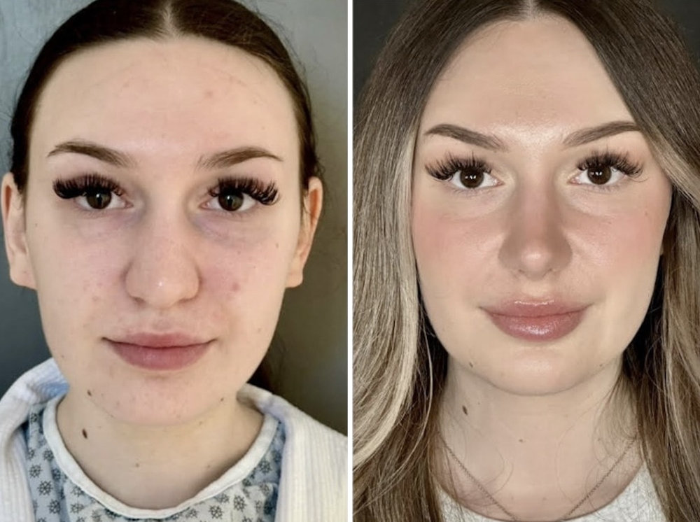 Bulbous nose rhinoplasty cost range in Toronto is displayed visually