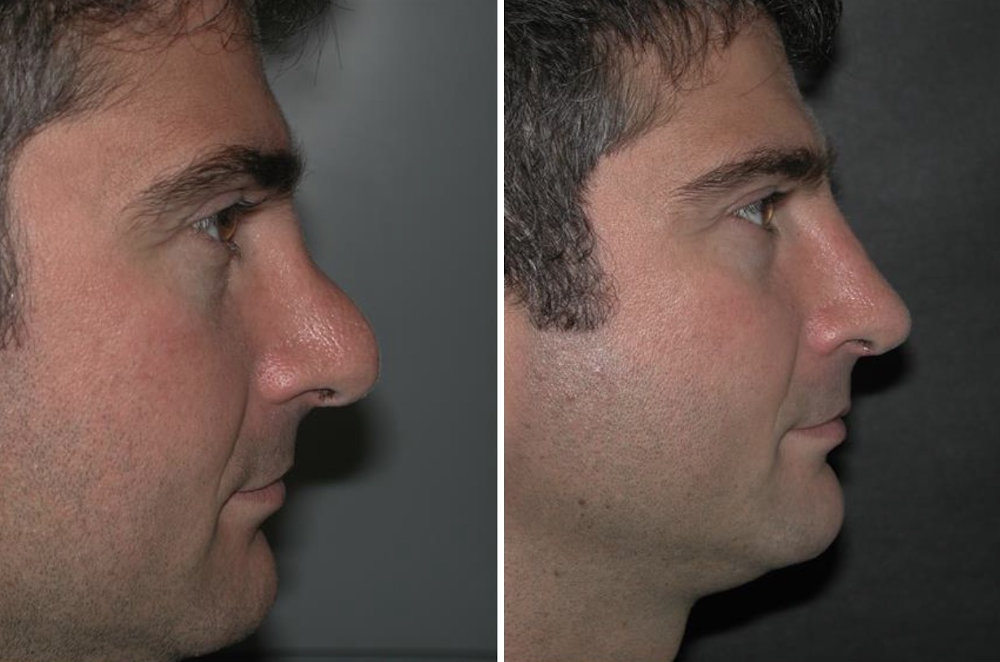 Digital 3D imaging used during a bulbous nose rhinoplasty consultation in Toronto