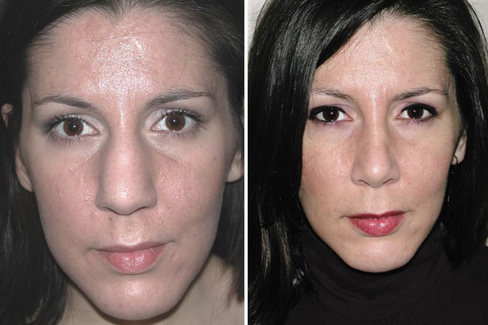 Rhinoplasty revision Case 57 showing nasal tip refinement results by Dr. Richard Rival
