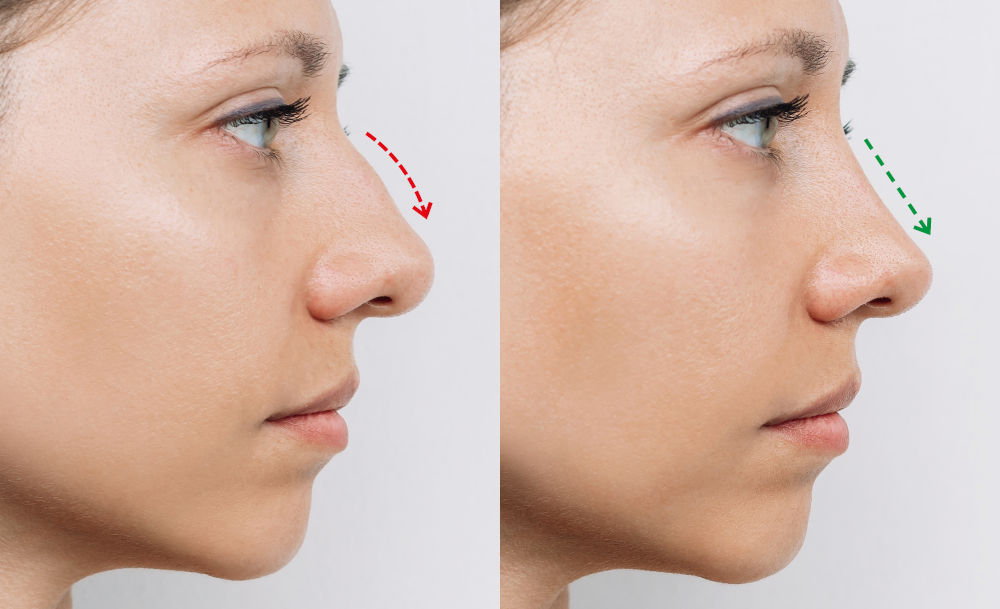Rhinoplasty Fixes a Crooked Nose