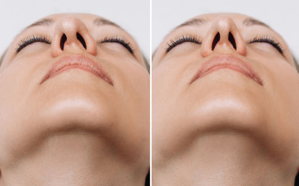 Rhinoplasty Fixes a Crooked Nose