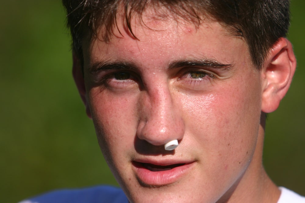 Young boy with a broken nose and cotton packed in the nostril after nasal injury