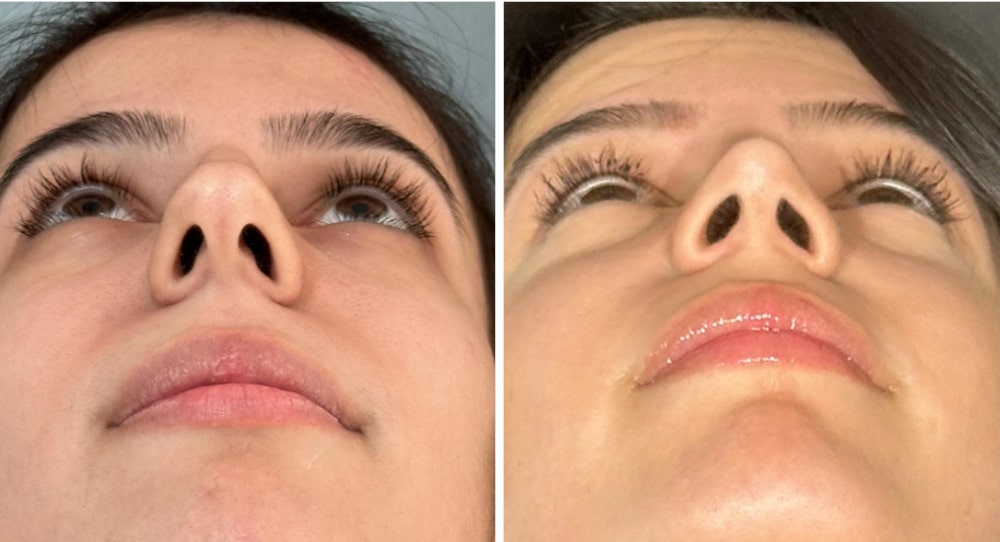 Dr. Richard Rival performing nostril reduction surgery in Toronto