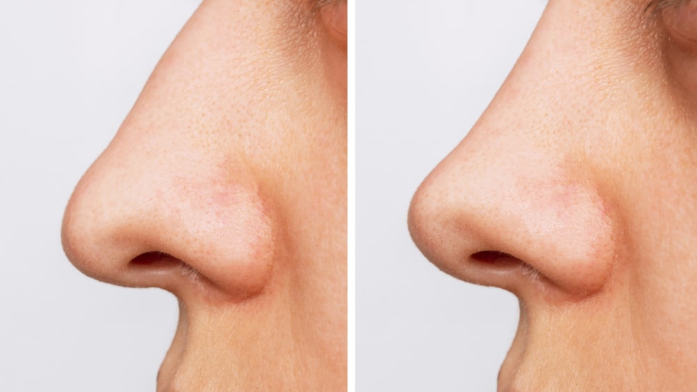 Profile view of a woman's nose before and after alar base reduction (alarplasty), showing nostril narrowing and refined nose tip.