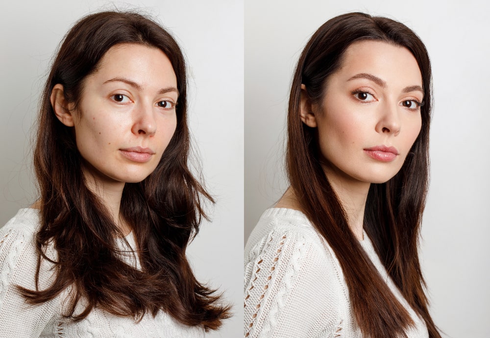 Woman before and after alar base reduction (alarplasty), highlighting nostril narrowing and improved nose tip symmetry.