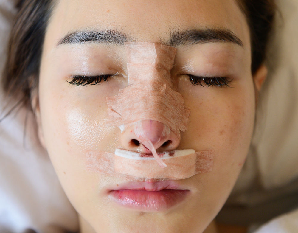 The Rhinoplasty Swelling Timeline