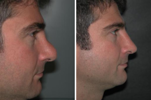 Revision Case 2: Before & After