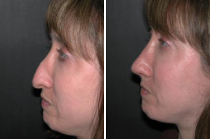 Revision Case 3: Before & After