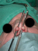 Internal approach rhinoplasty with tip cartilages pulled into nostrils.