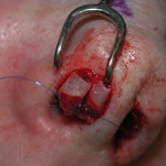 Suture in nasal tip cartilages