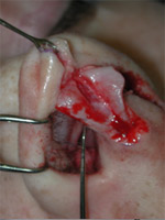Nasal incision and exposed cartilages.