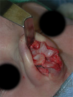 External approach rhinoplasty showing very irregular and asymmetric nasal tip cartilages.