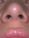 External rhinoplasty incision at 1 year after surgery.