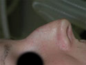 Nasal profile prior to hump reduction.