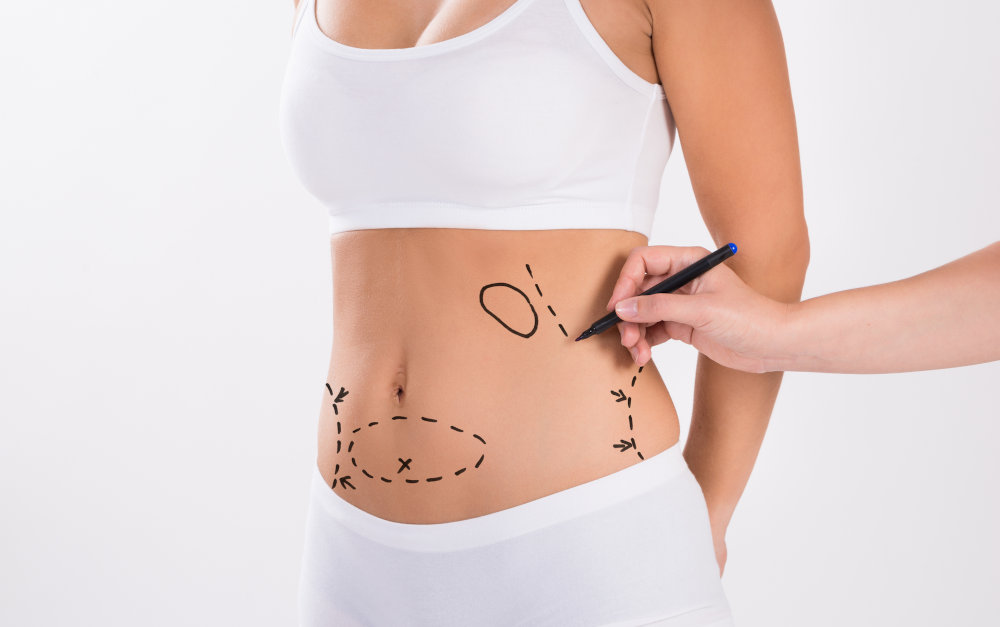 Liposuction Procedure and Cost Breakdown in Toronto Surgeon preparing a patient for liposuction and marking treatment areas