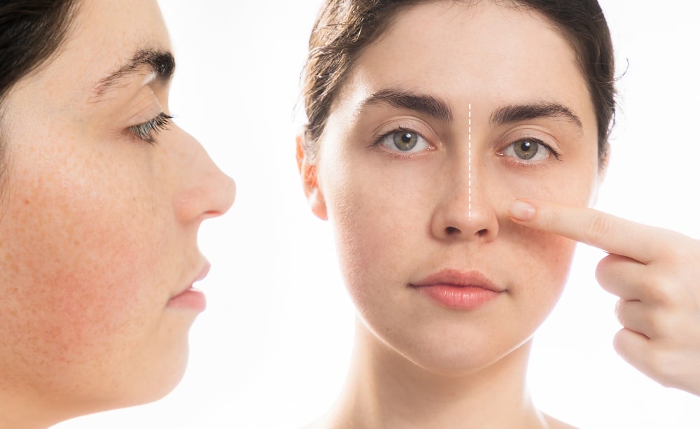 Comparison of cartilage, silicone, and Gore-Tex used in rhinoplasty procedures