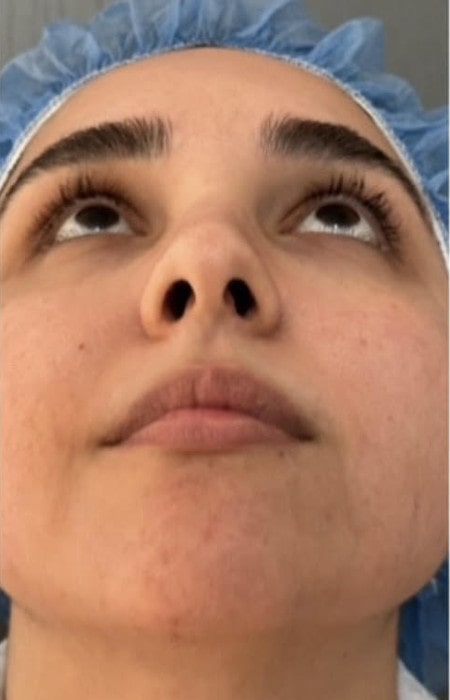 Rhinoplasty – 1 year after surgery showing refined nose from the front