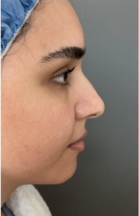 Rhinoplasty – 1 year after surgery showing refined nose profile