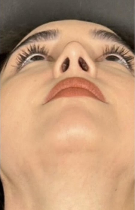 Rhinoplasty – one year after surgery front view showing stable results and refined appearance