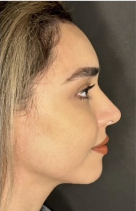Rhinoplasty – one year after surgery side profile showing harmonious nasal contour