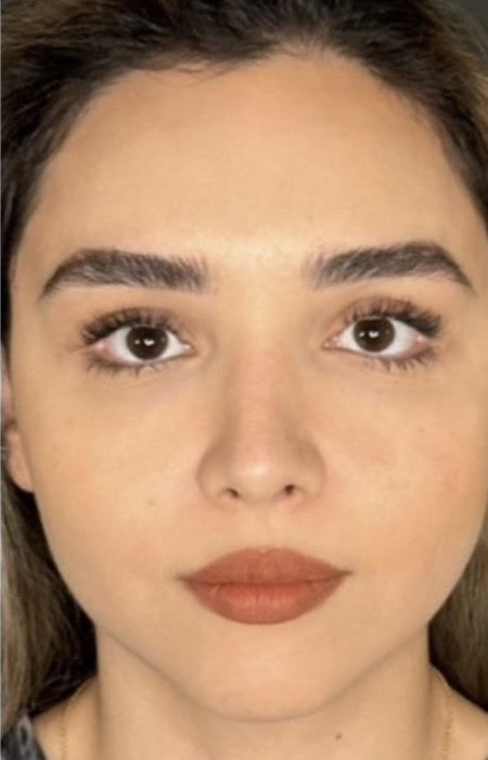 Rhinoplasty – after surgery front view showing straighter bridge and refined nasal tip