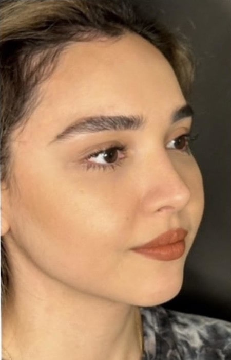 Rhinoplasty – after surgery side profile with smoother bridge and natural contour