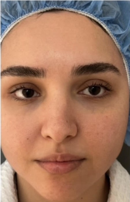 Rhinoplasty – before surgery showing patient’s nose from the front view