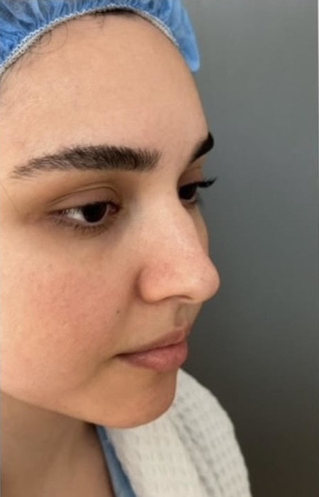 Rhinoplasty – before surgery showing patient’s nose profile