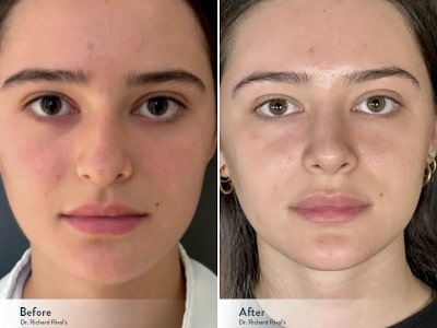 Revision Rhinoplasty Before and After