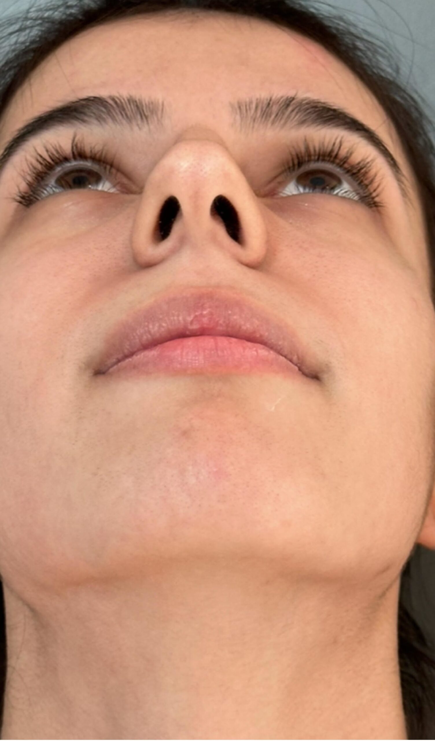 Rhinoplasty – 4 months after surgery showing smoother and more balanced nose from the profile