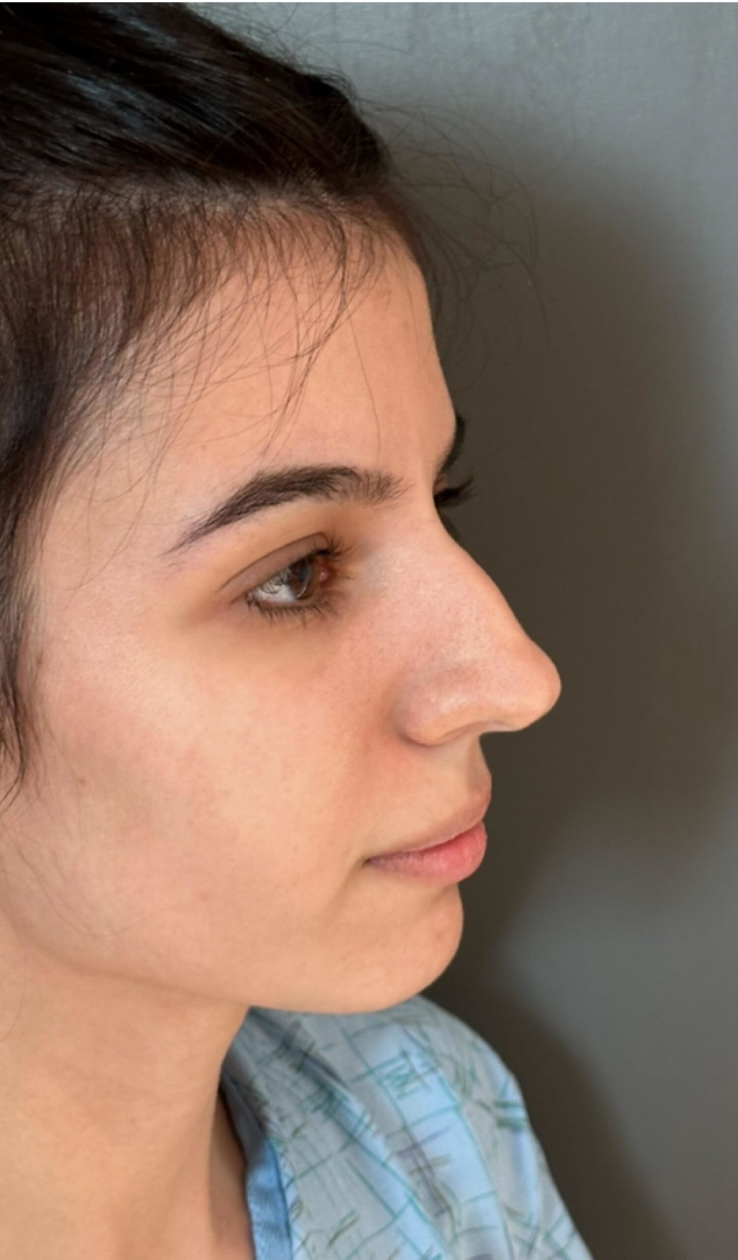 Rhinoplasty – 4 months after surgery showing improved side profile and refined tip