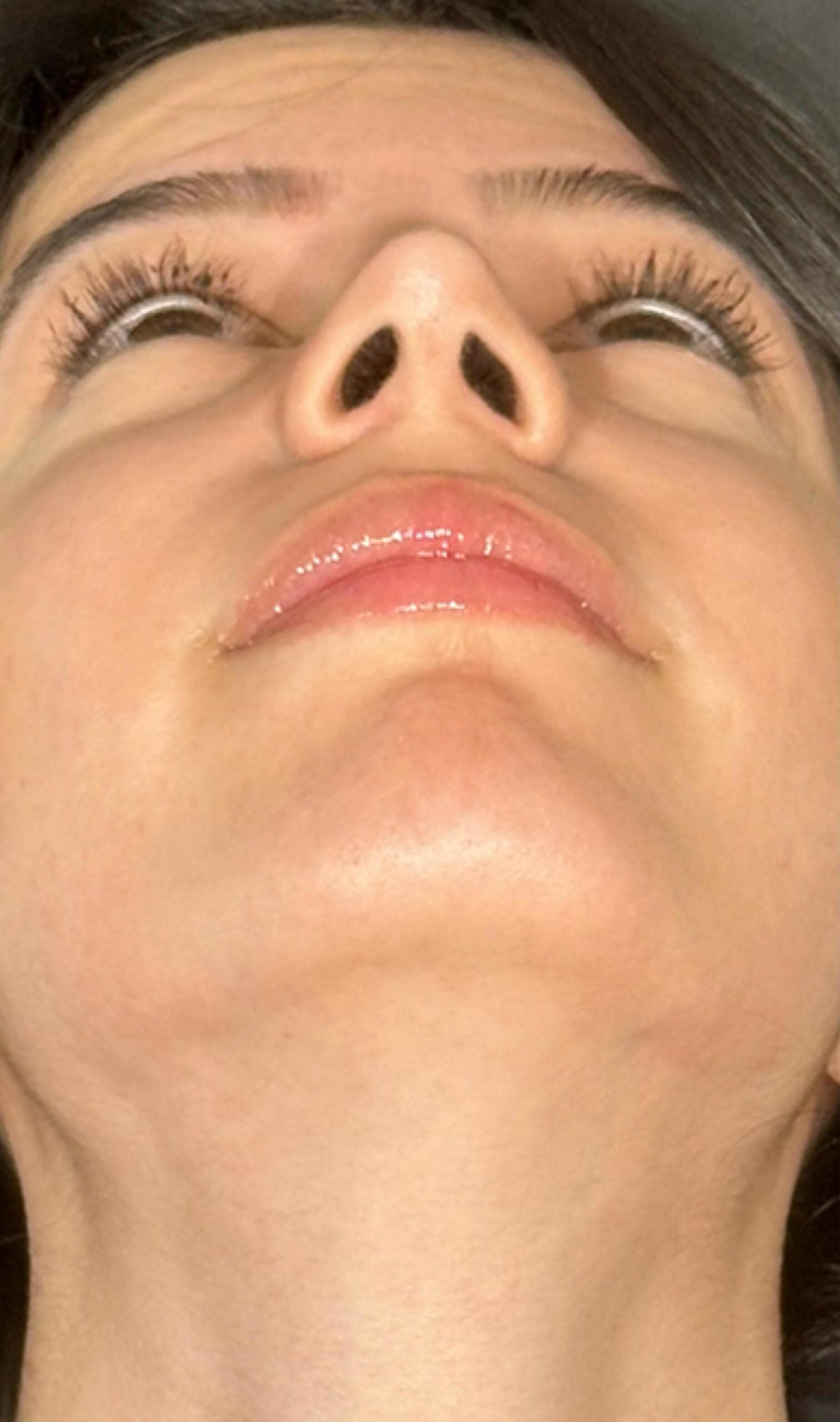 Rhinoplasty – four months post-op profile view showing stable, balanced nose and tip