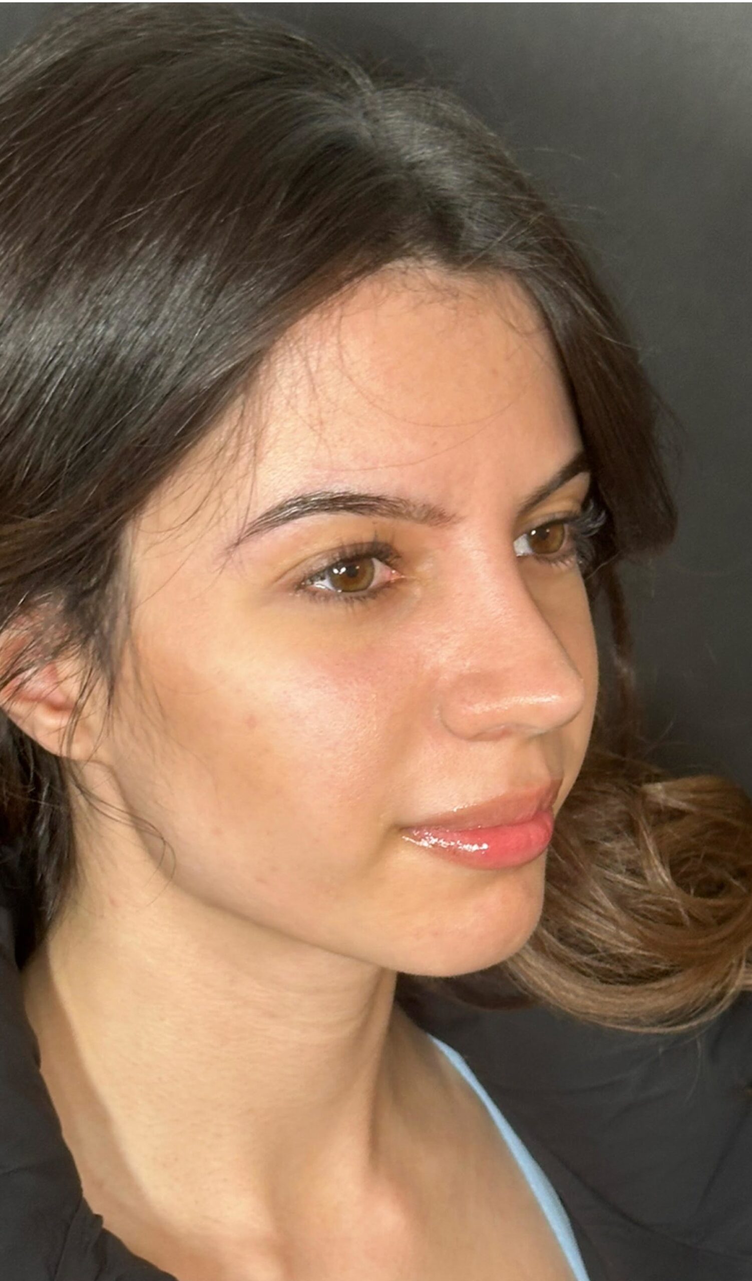 Rhinoplasty – four months post-op side profile showing improved tip and harmonious nasal shape