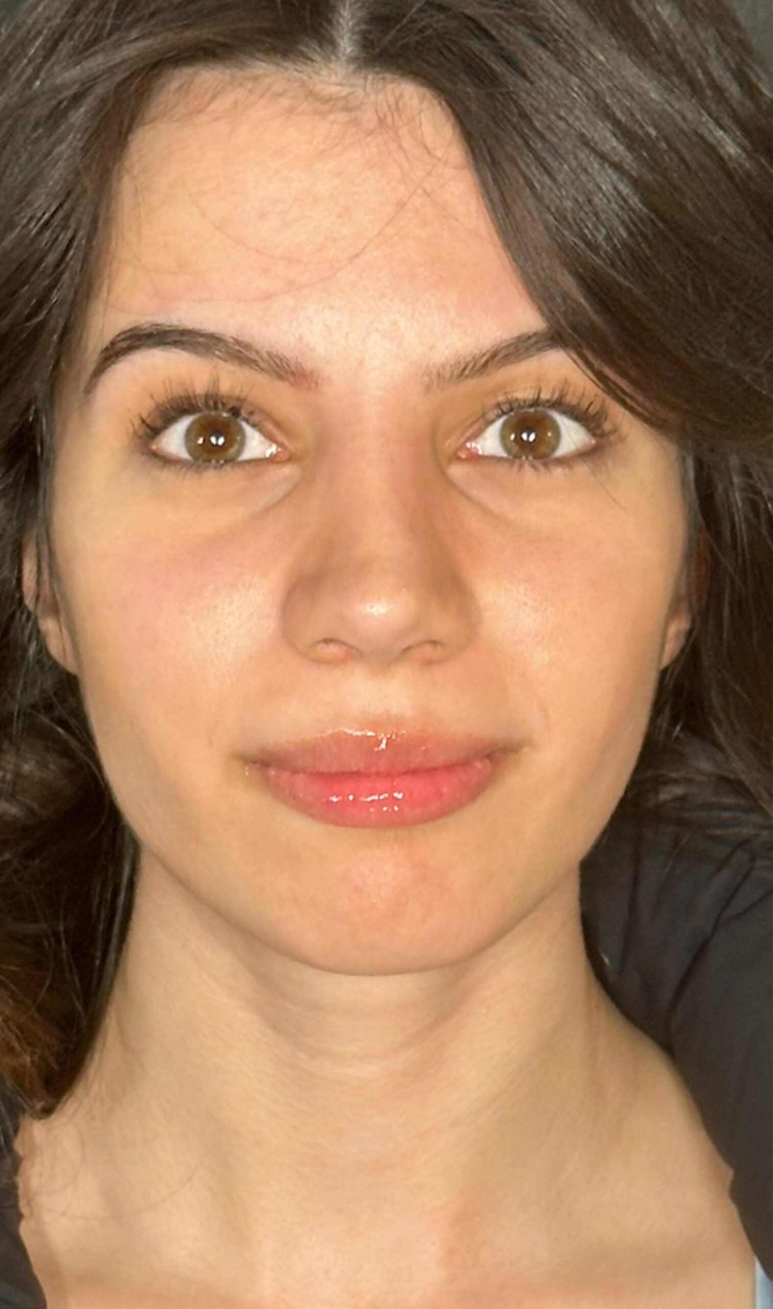 Rhinoplasty – after surgery front view showing refined nasal bridge and balanced tip