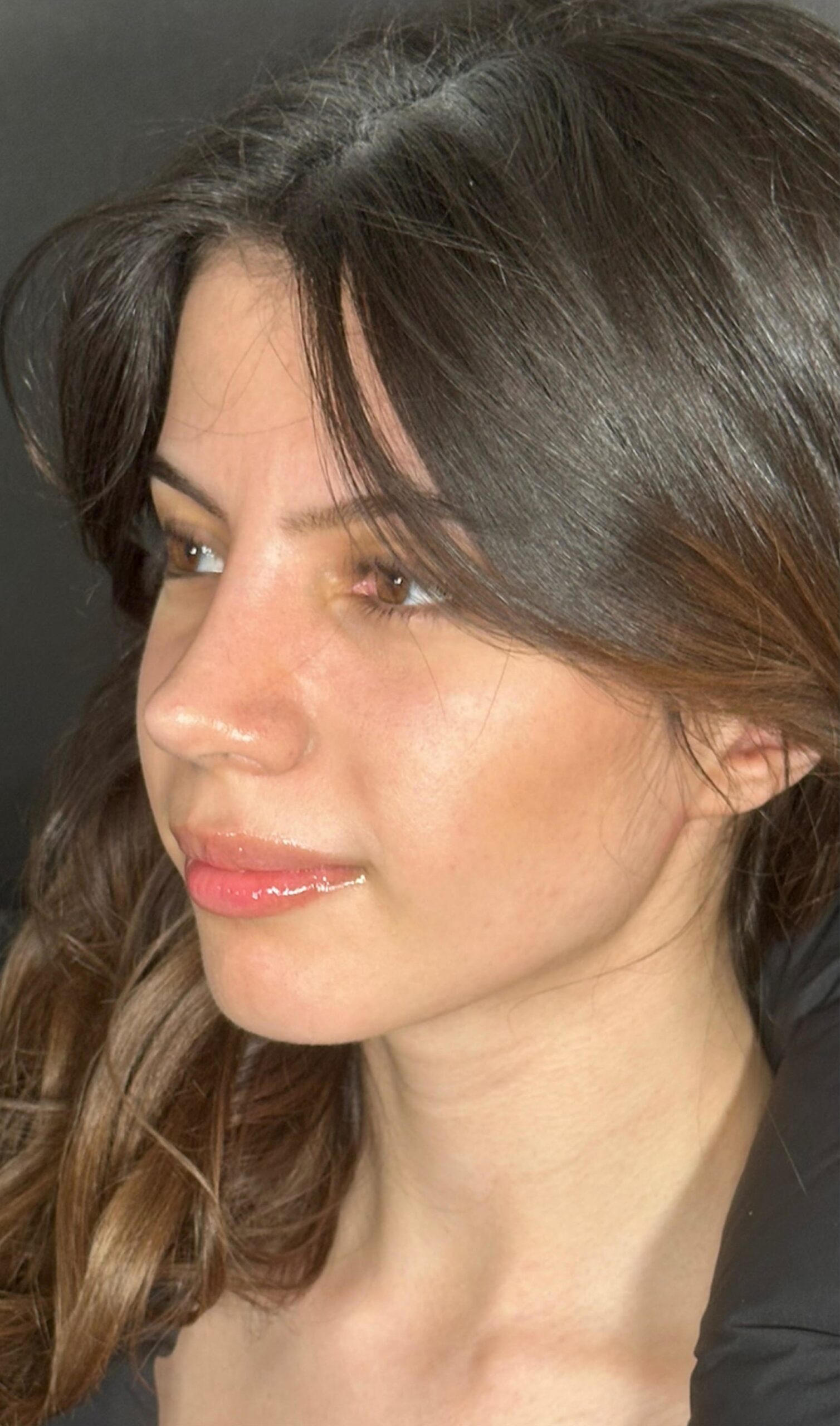Rhinoplasty – after surgery side profile showing smoother bridge and lifted tip