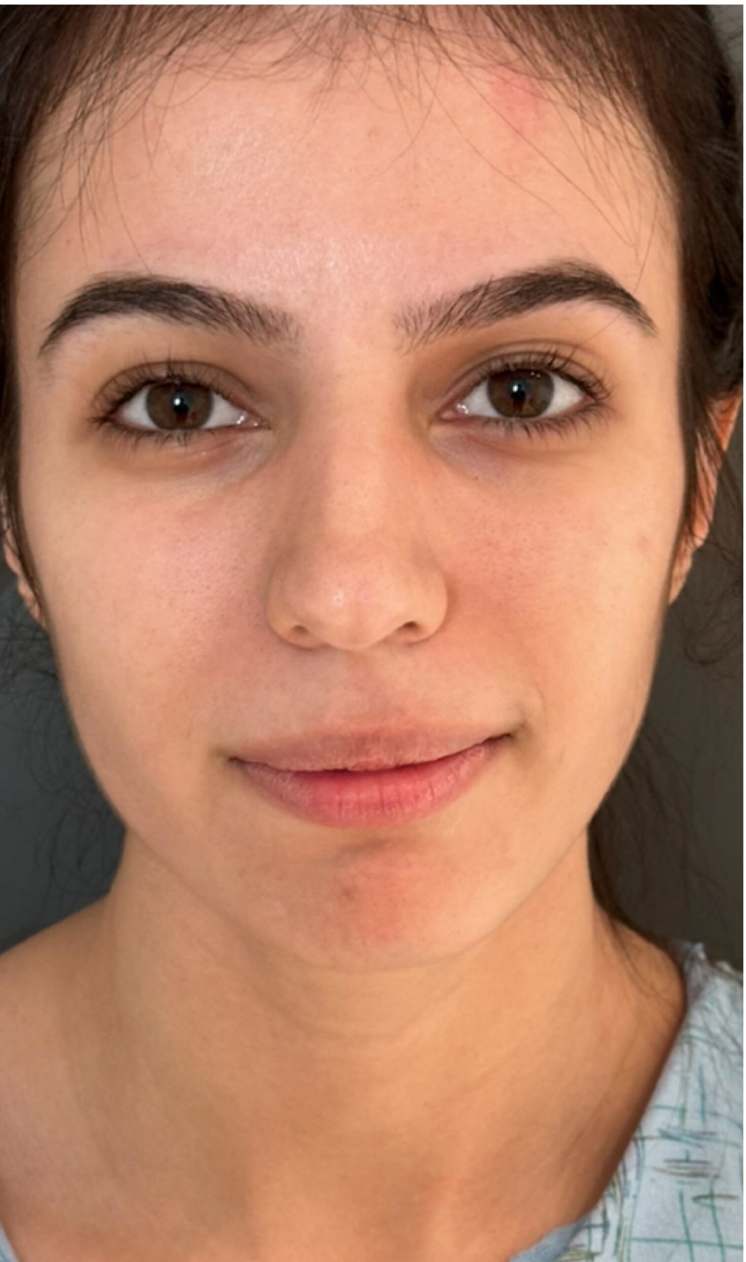 Rhinoplasty – before surgery showing patient’s nose from the front with dorsal bridge and tip concerns