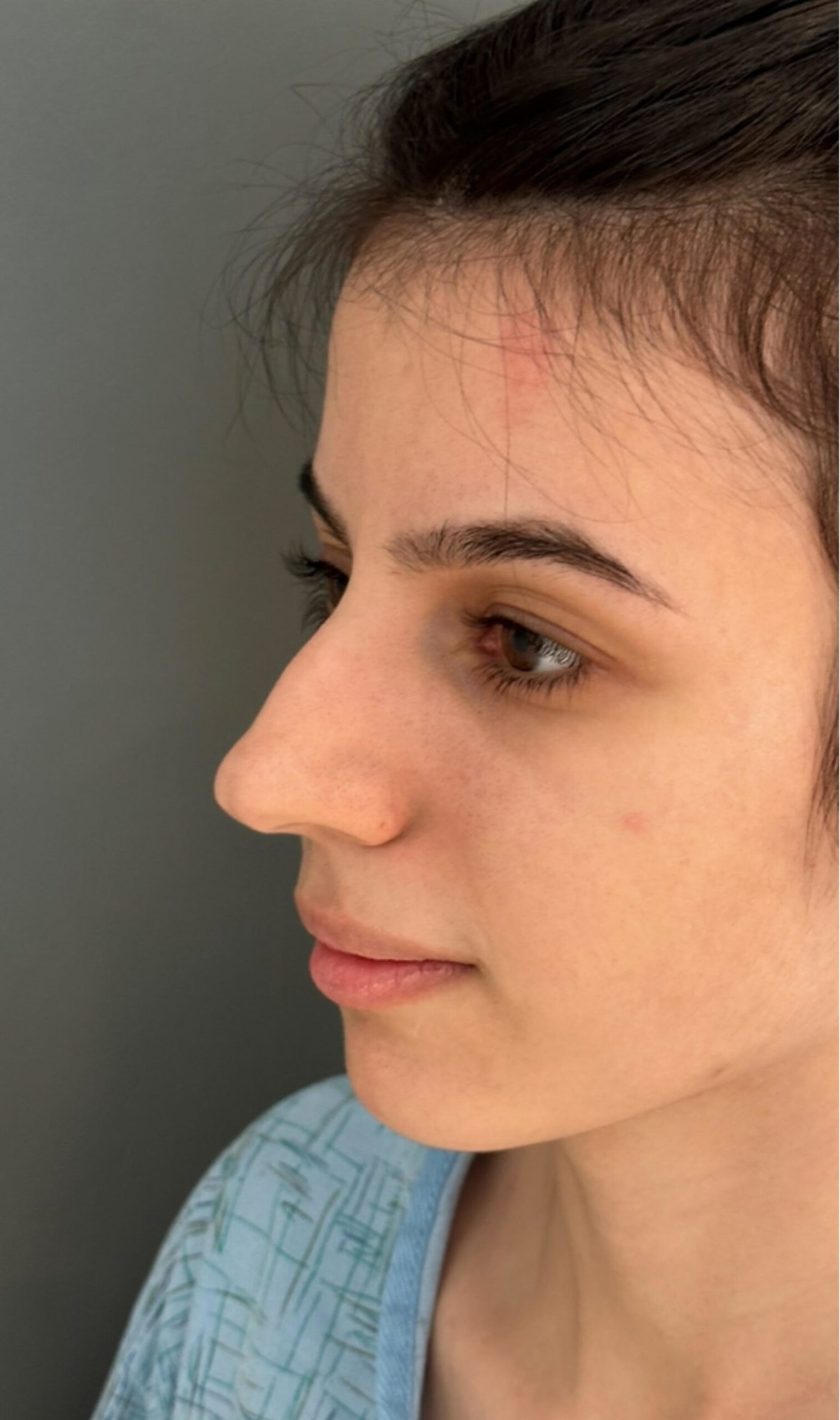Rhinoplasty – before surgery showing side profile of nose with bridge and tip concerns
