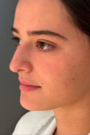 Rhinoplasty – 4 months after surgery showing smoother, more balanced nose from the front