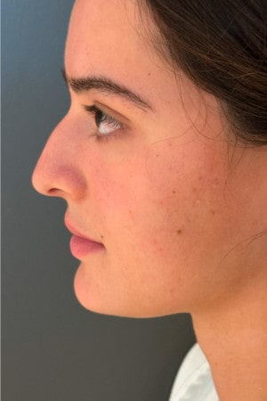 Rhinoplasty – 4 months after surgery showing improved nose profile and refined tip