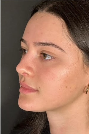 Rhinoplasty – four months post-op front view showing stable refinement and improved proportions