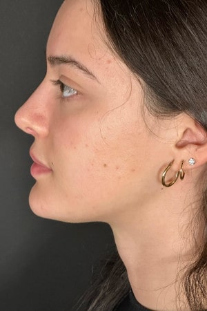 Rhinoplasty – four months post-op side profile showing smoother bridge and harmonious contour