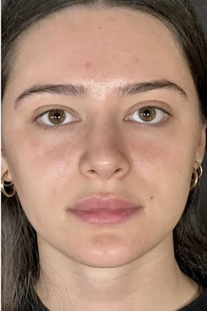 Rhinoplasty – after surgery front view showing straightened bridge and lifted nasal tip