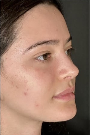 Rhinoplasty – after surgery side profile showing smooth bridge and refined tip position