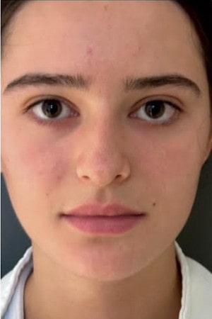 Rhinoplasty – before surgery showing patient’s nose from the front with dorsal bump and droopy tip