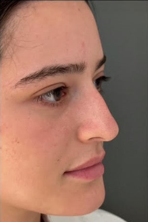 Rhinoplasty – before surgery showing patient’s nose profile with bump and droopy tip