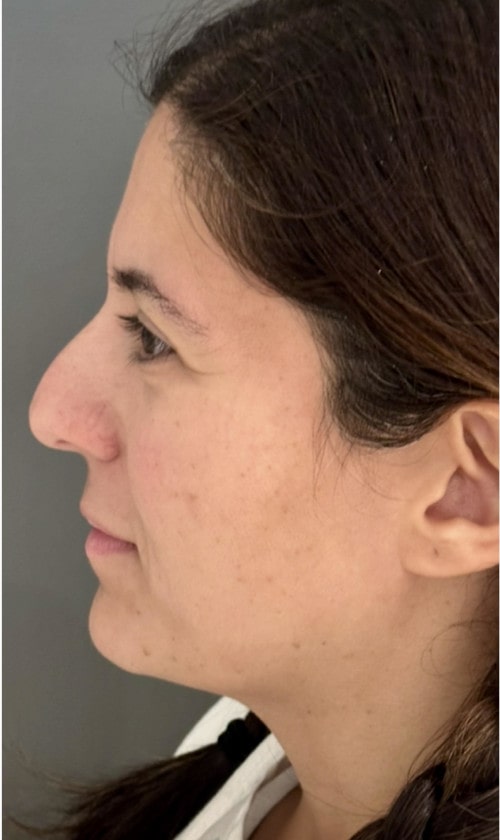 Rhinoplasty – 1 year after surgery showing reduced bump and lifted tip from the front