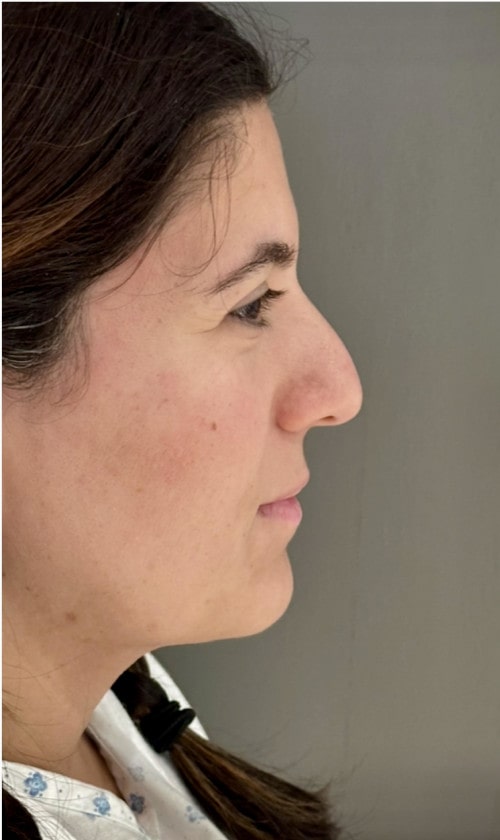 Rhinoplasty – 1 year after surgery showing straightened nose profile and refined tip