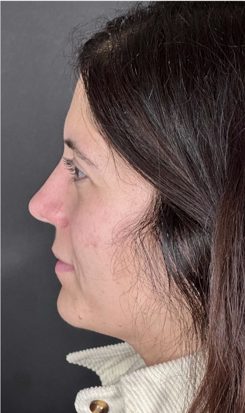 Rhinoplasty – one year post-op front view showing stable refined nasal shape and lifted tip