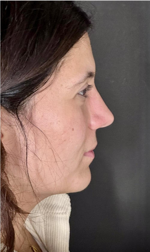 Rhinoplasty – one year post-op side profile showing straightened bridge and natural tip