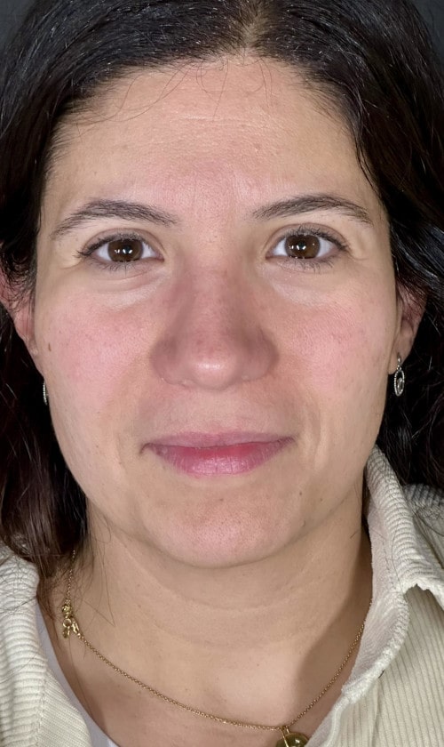 Rhinoplasty – after surgery front view showing smoothed nasal bridge and lifted tip